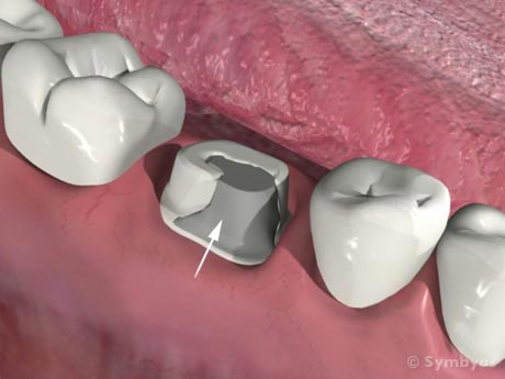 Core Build-Up Materials